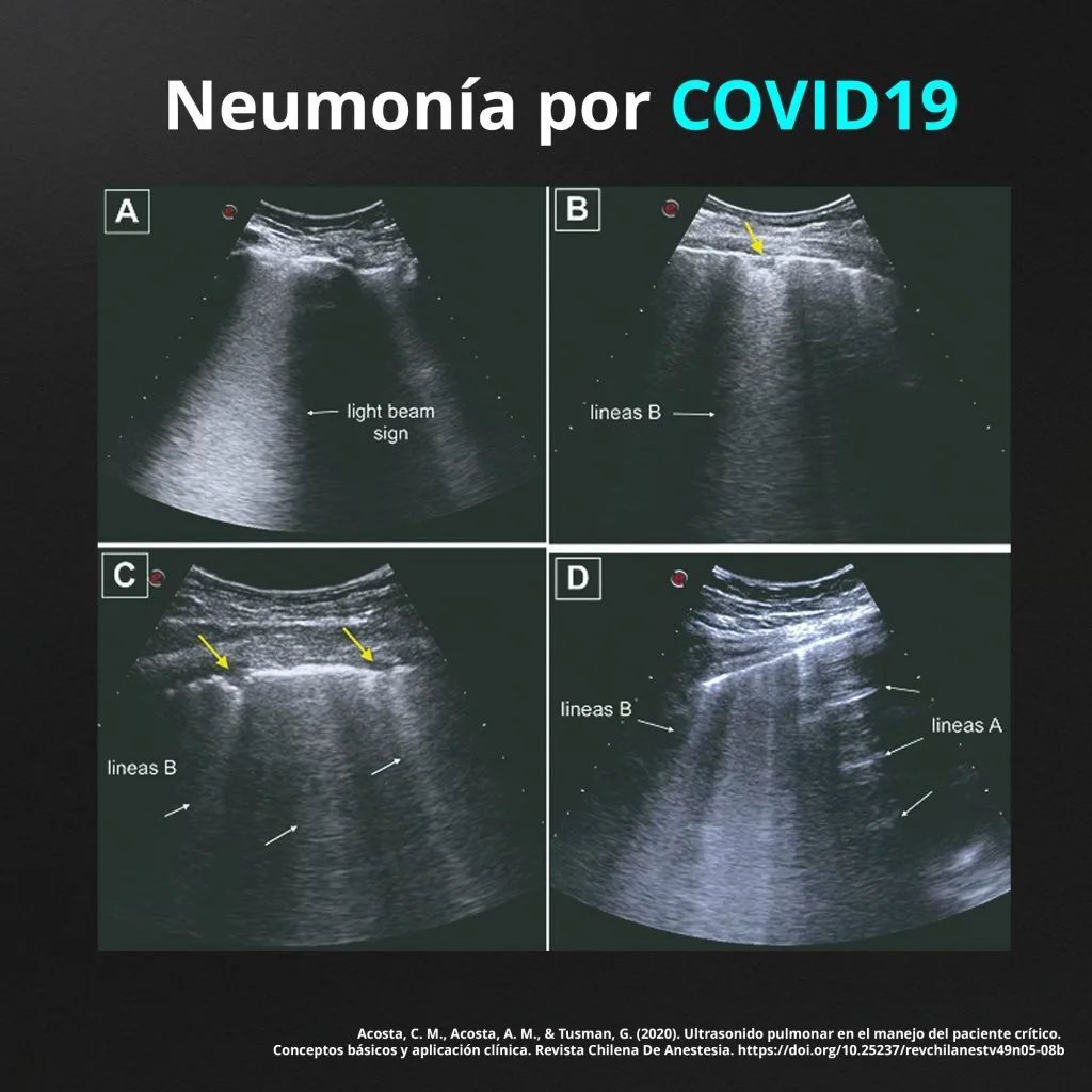 neumonía por covid en ecografía 