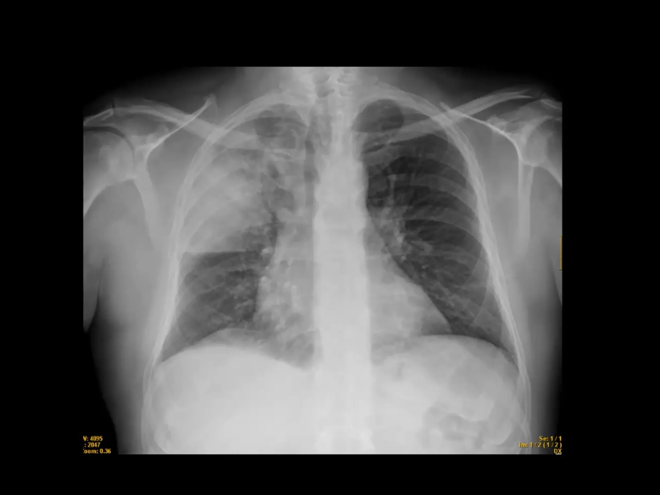 Curso de radiografía de tórax 4