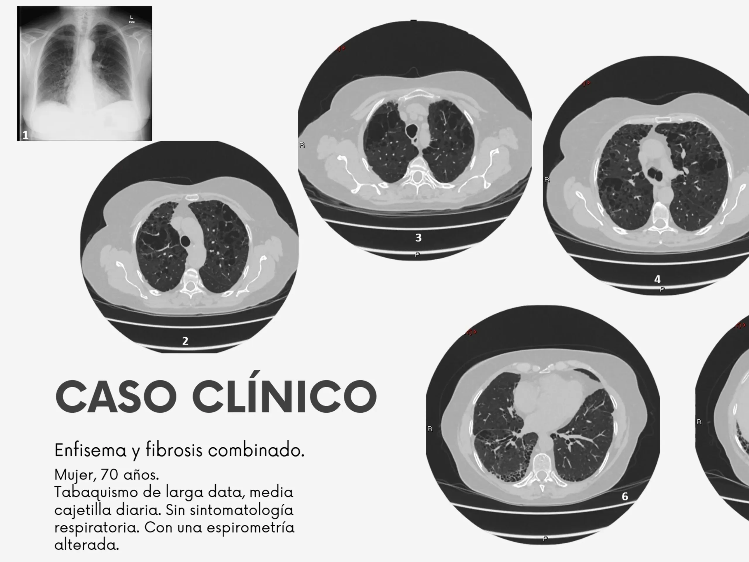 Curso de radiografía de tórax 5
